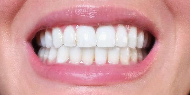 Smile 3 After Invisalign