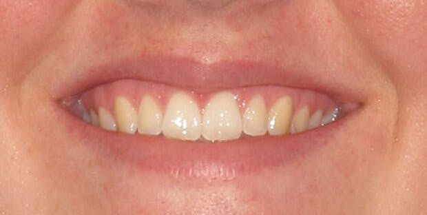 Smile 1 After Invisalign