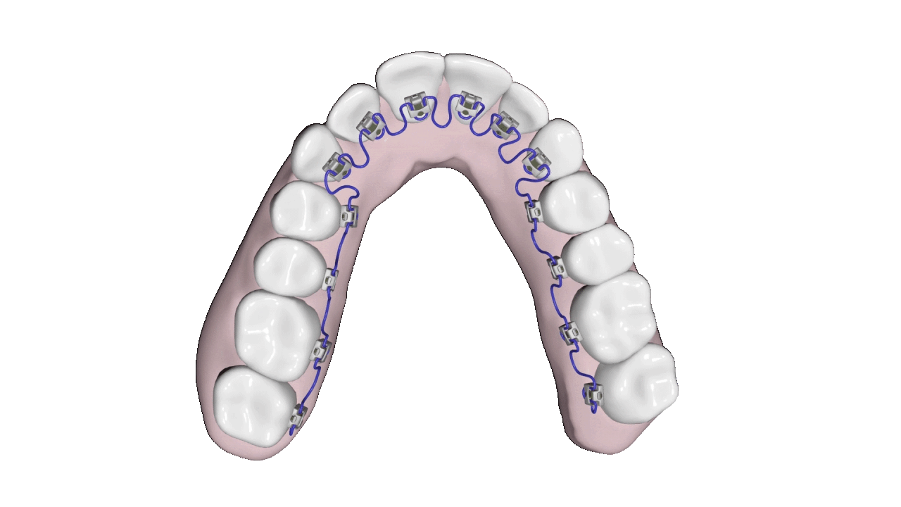 Animation of Breezy Braces inside of mouth