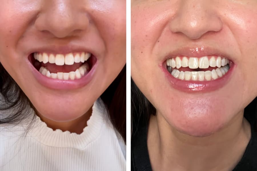 2 closeup images of smiling mouth. First with misaligned bottom teeth and slightly uneven top teeth, The second with straight and even teeth.