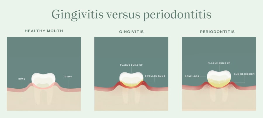 Three illustrations. First shows a healthy tooth and gums, next shows the effects of gingivitis, the third shows the effects of periodontitis.