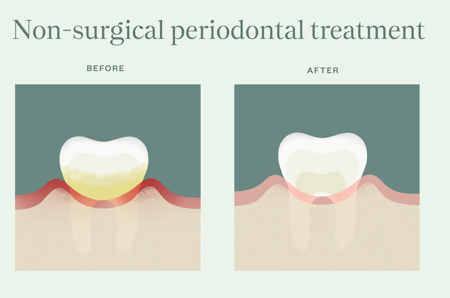Illustration of 3 teeth before and after non-surgical gum treatment.
