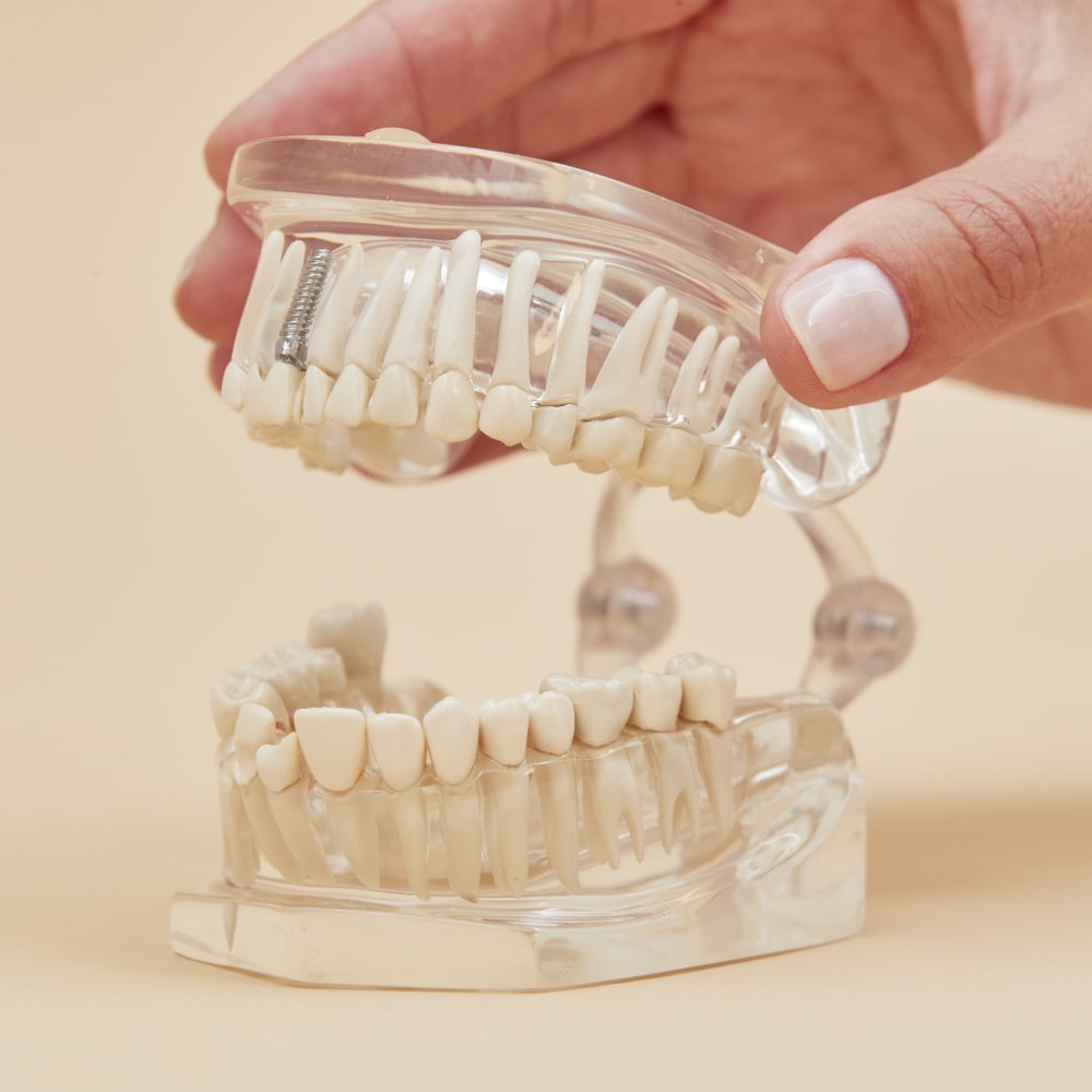A model of a mouth with a dental implant.